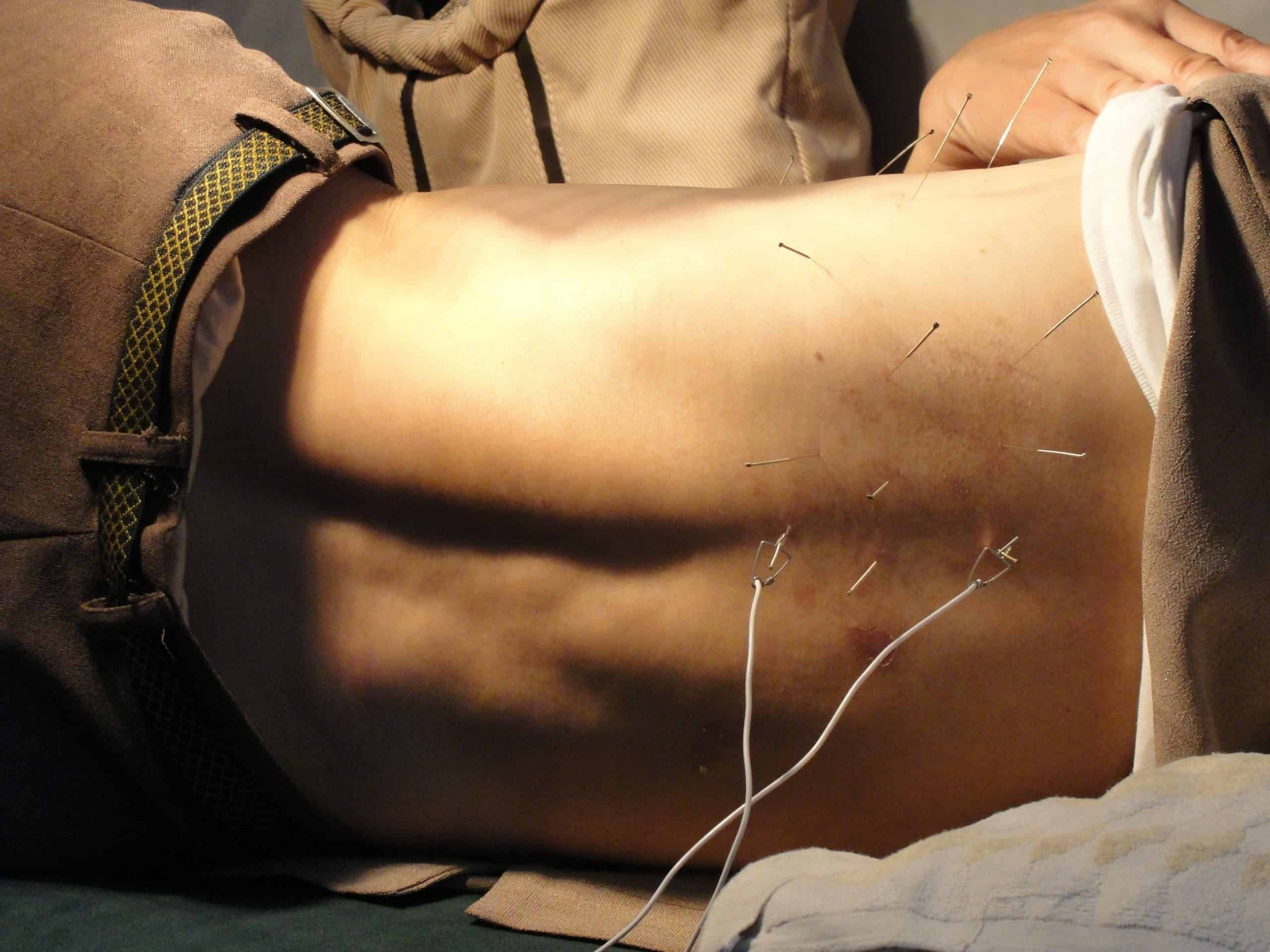 A man lies on his side with no shirt. On his back are a variety of acupuncture needles, some hooked to wires